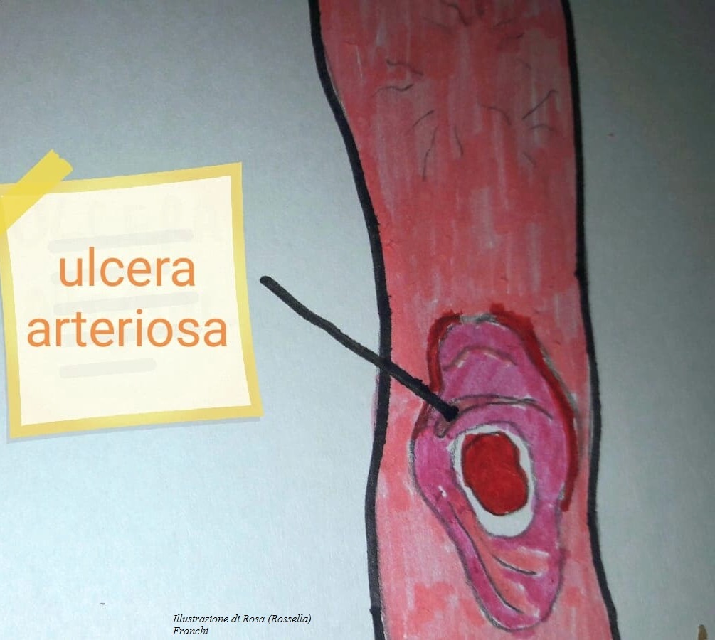 ulcera arteriosa, Curare l&#8217;ulcera arteriosa con il sistema “CELUTION”