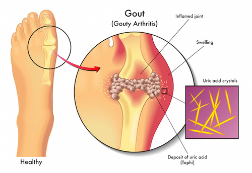 Gotta, Gotta e iperuricemia: di cosa si tratta?