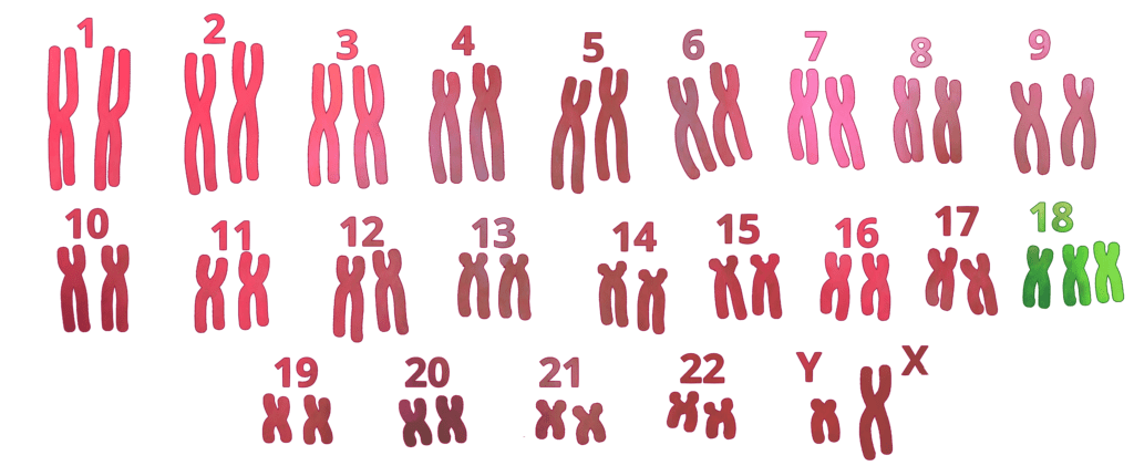 , Quando i cromosomi si fanno in tre- Storia di trisomie annunciate